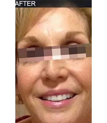 After Image: Botox - front