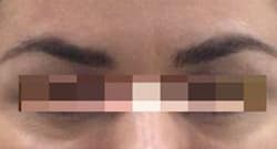 After Image: Botox - front