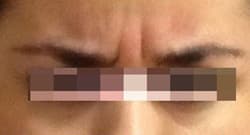 Before Image: Botox - front