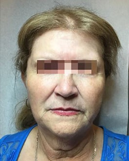 After Image: Dermal Filler - front