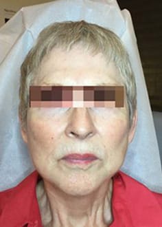 Before Image: Dermal Filler - front