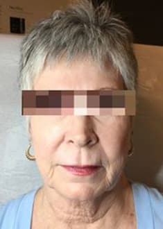 Before Image: Dermal Filler - front