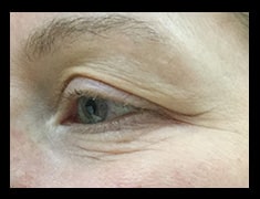 Before Image: Fractora RF - left-front-oblique