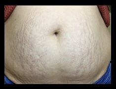 Before Image: Fractora - front
