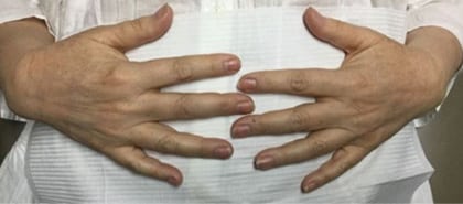After Image: IPL/Photofacial - front