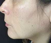 After Image: IPL/Photofacial - left-side