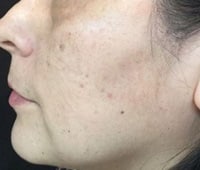 Before Image: IPL/Photofacial - left-side