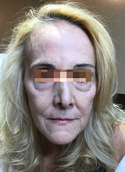 After Image: IPL/Photofacial - front
