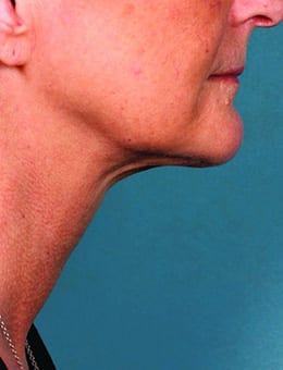After Image: Kybella - right-side