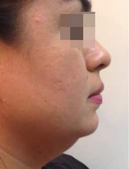Before Image: Kybella - right-side