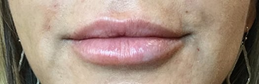 After Image: Lip Filler - front