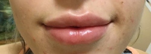 After Image: Lip Filler - front