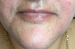 Before Image: Lip Filler - front