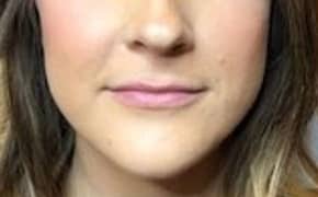 Before Image: Lip Filler - front