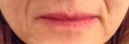 Before Image: Lip Filler - front