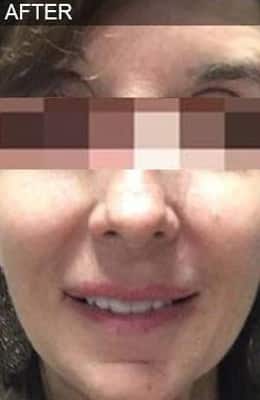 After Image: Liquid Facelift - front