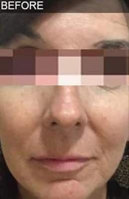 Before Image: Liquid Facelift - front