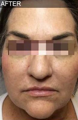 After Image: Liquid Facelift - front