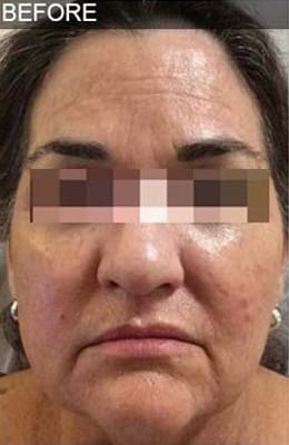 Before Image: Liquid Facelift - front