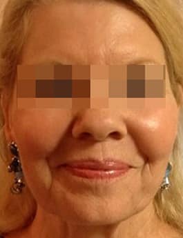 After Image: Voluma - front
