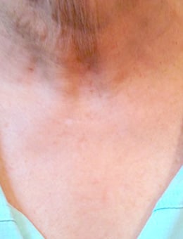 After Image: IPL/Photofacial - front