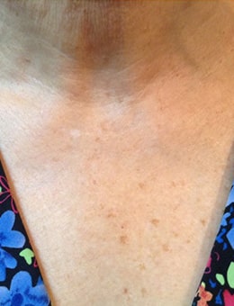 Before Image: IPL/Photofacial - front