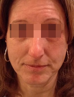 Before Image: Voluma, Juvederm and Botox - front