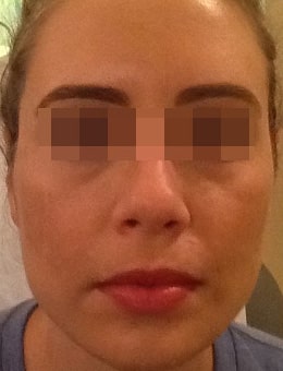 After Image: Voluma, Juvederm and Botox - front