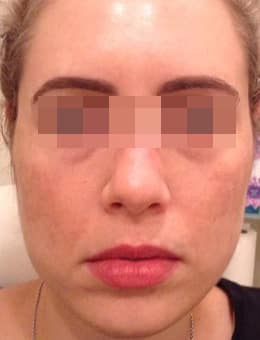 Before Image: Voluma, Juvederm and Botox - front
