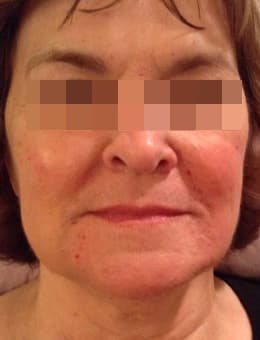 After Image: Juvederm and Voluma - front