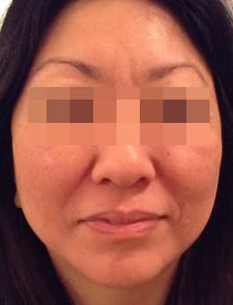 After Image: Juvederm and Voluma - front