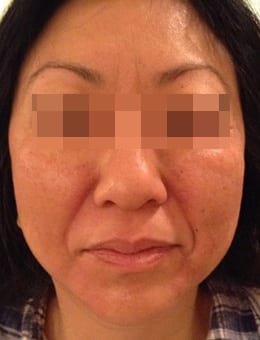 Before Image: Juvederm and Voluma - front