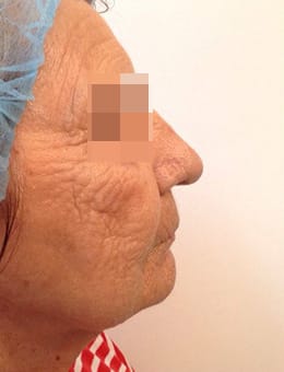 After Image: IPL/Photofacial - right-side