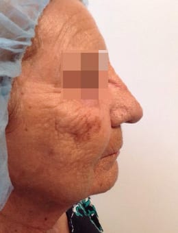Before Image: IPL/Photofacial - right-side