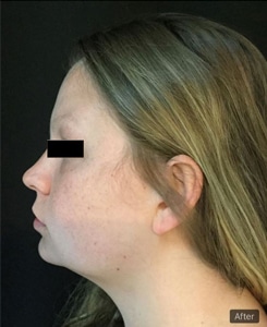 After Image: Sculpsure - left-side