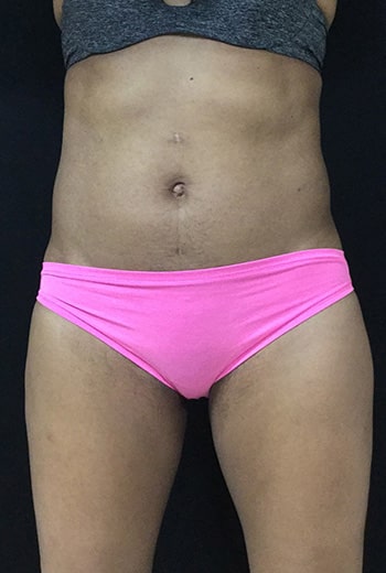 After Image: Sculpsure - front