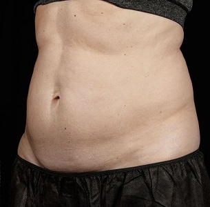 After Image: Sculpsure - left-front-oblique