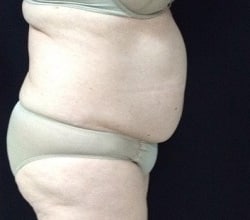 Before Image: Sculpsure - right-side