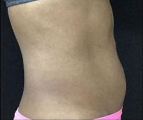 After Image: Sculpsure - right-side