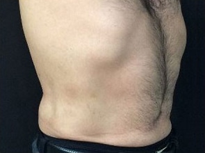 After Image: Sculpsure - right-front-oblique