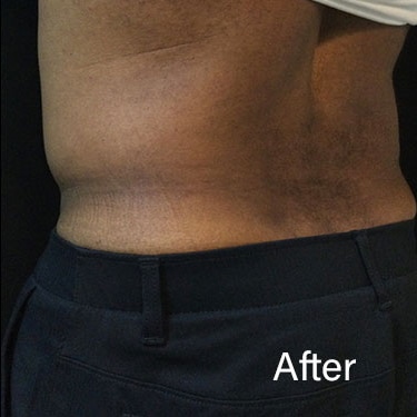After Image: Sculpsure - left-back-oblique