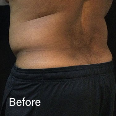 Before Image: Sculpsure - left-back-oblique