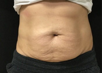 Before Image: Sculpsure - front