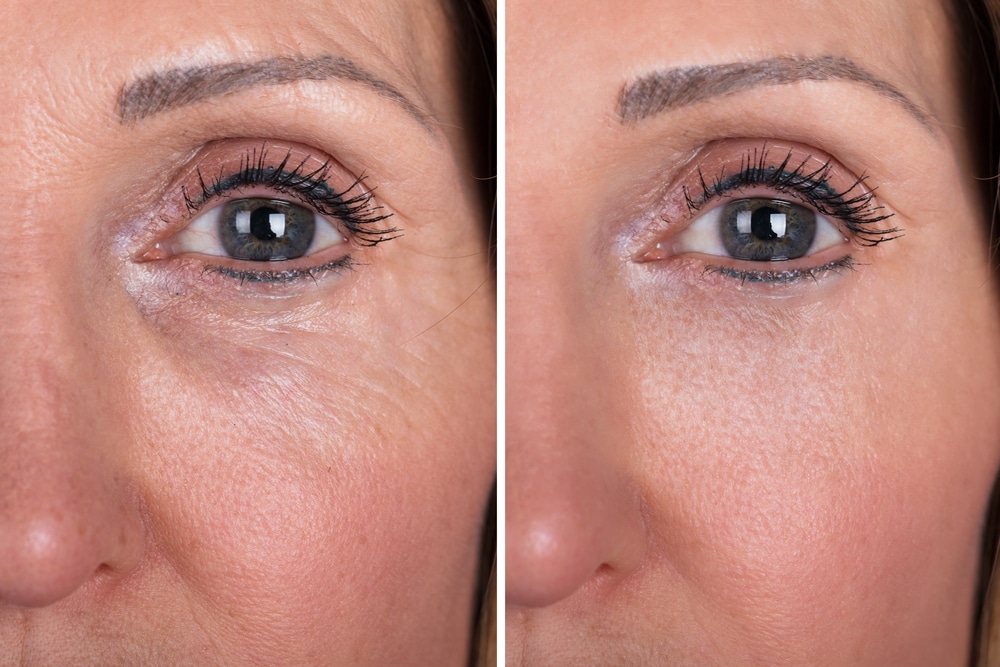 Woman With Before And After Rejuvenation
