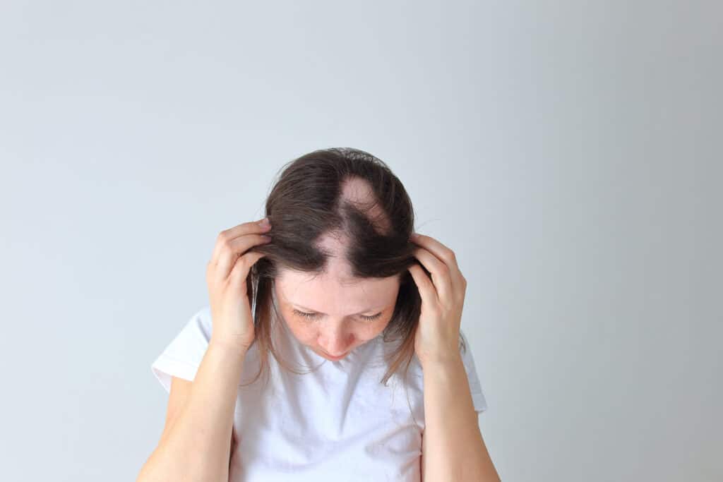 A woman with bald patches before PRP hair restoration in San Antonio