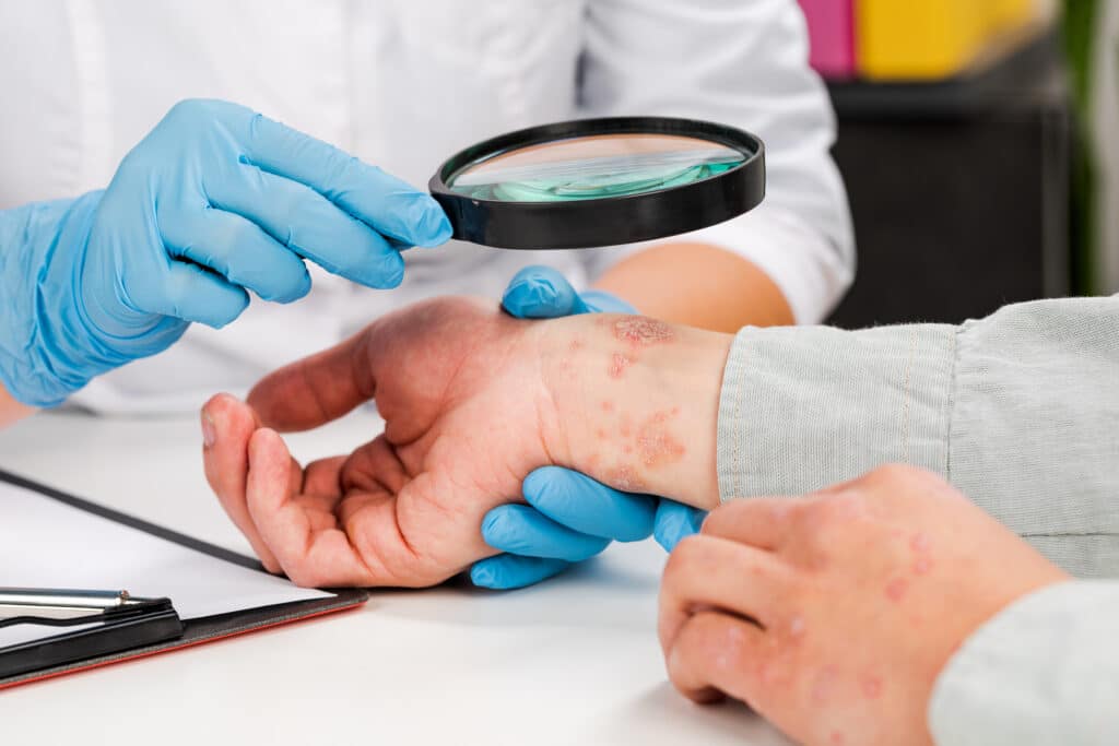 A dermatologist examining a patient with dyshidrotic eczema on their hands