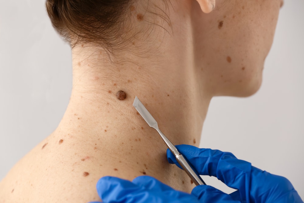 A dermatologist removing a mole with a lancet
