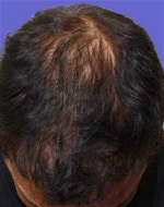 after Image of Hair Restoration San Antonio TX