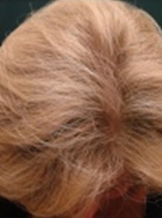 after Image of Hair Restoration Procedure San Antonio TX
