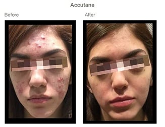 Before & After Image of Accutane Acne Medication San Antonio TX